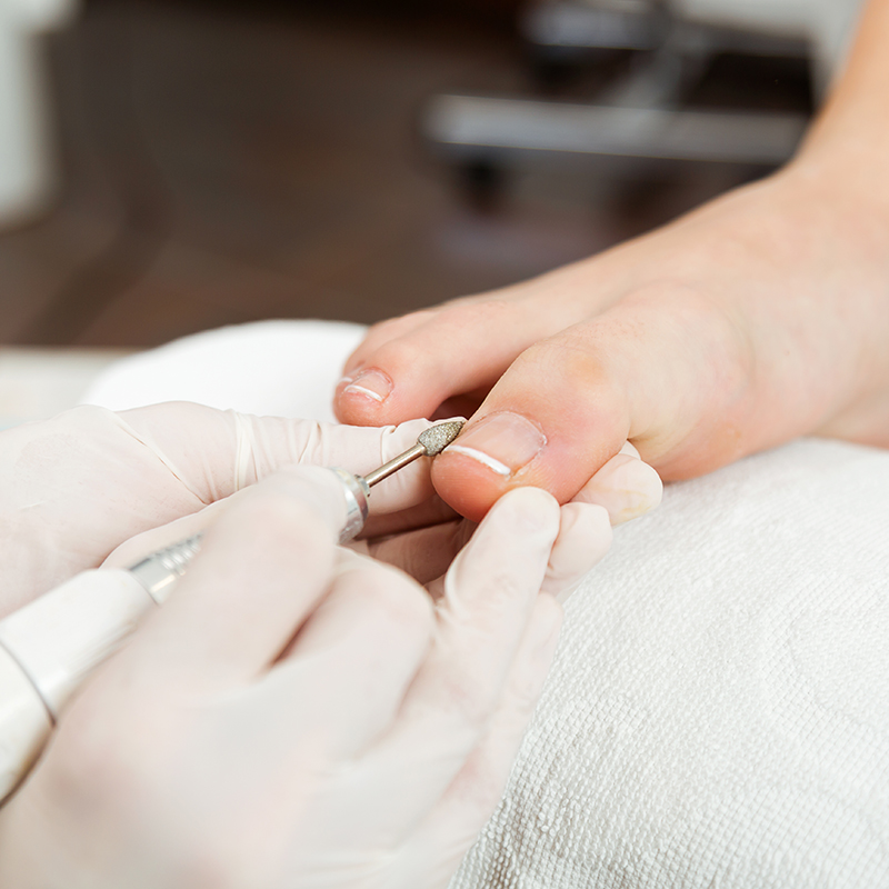 Kalknagel of schimmelnagel laten behandelen bij Pedicure Vleuten